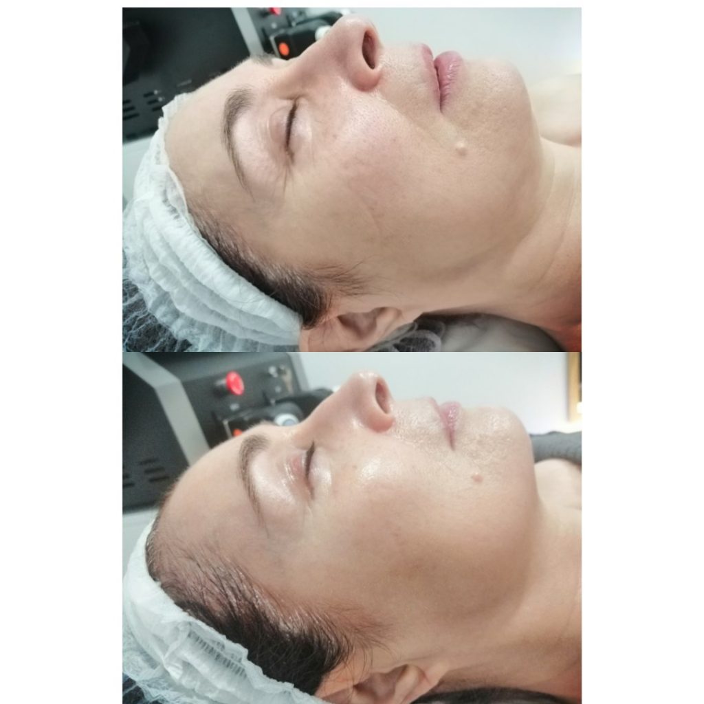 PROTHEUS Rejuvenecimiento y Matis