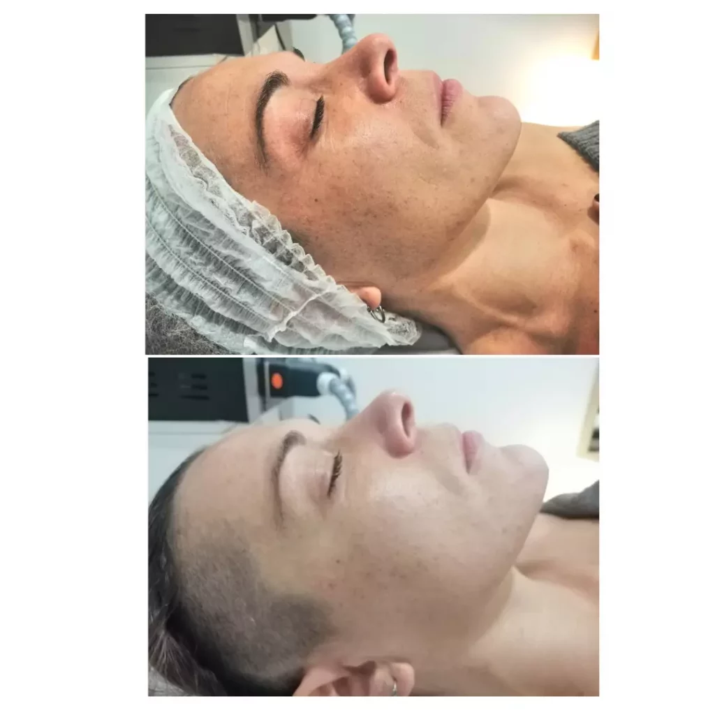 PROTHEUS Carbón Activo